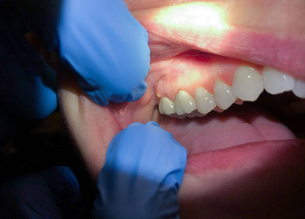 Best Emergency Gum Treatment in Pearson, GA